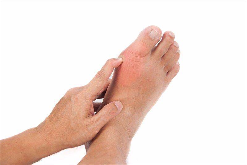 Gejala tersering dari gout arthritis adalah pembengkakan di sendi ibu jari kaki yang sangat nyeri, merah, dan panas.(mymed.com)