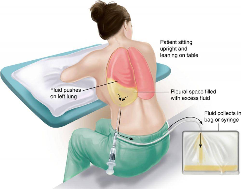 ilustrasi torakosentesis (healthjade.net)