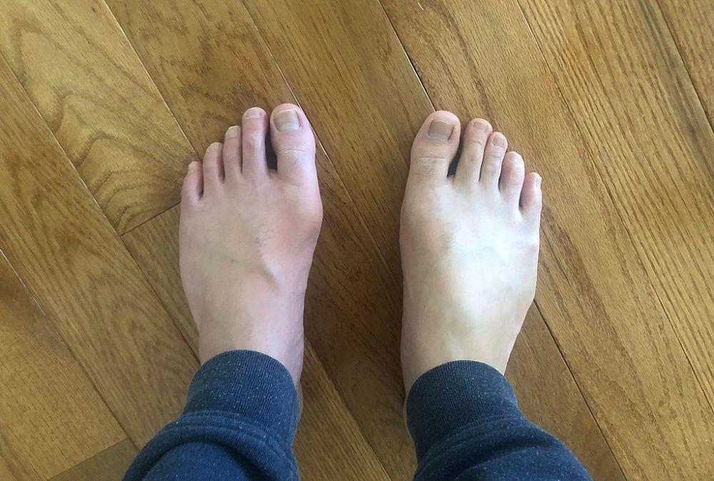 Studi: Sindrom Metabolik Tingkatkan Risiko Gout