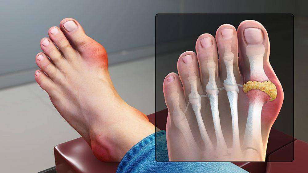 ilustrasi artritis gout (commons.wikimedia.org/Scientific Animations)