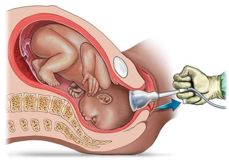 ilustrasi proses kelahiran dengan vacuum extraction (dailypregnancytips.com)