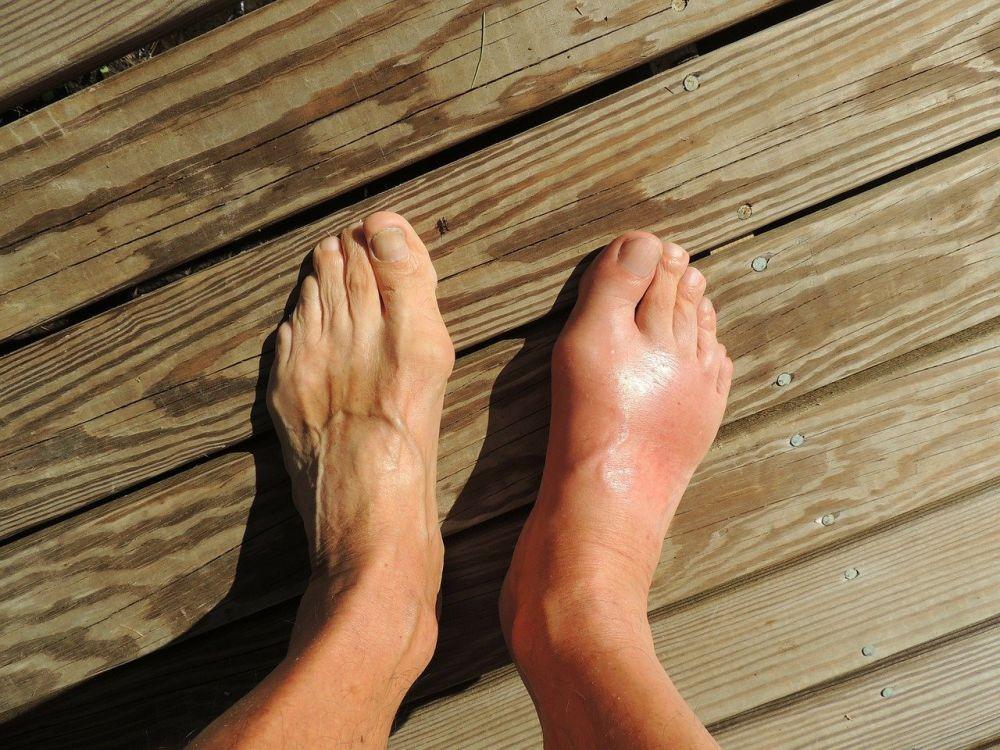 Artritis Gout: Penyebab, Gejala, Diagnosis, dan Pengobatan