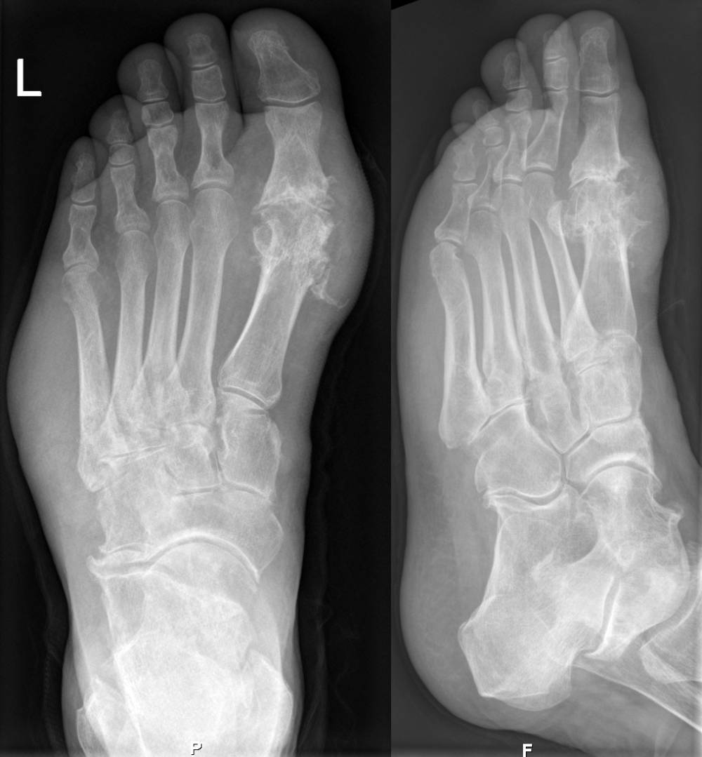 ilustrasi foto sinar-X kaki pada orang dengan gout artritis (commons.wikimedia.org/Hellerhoff)