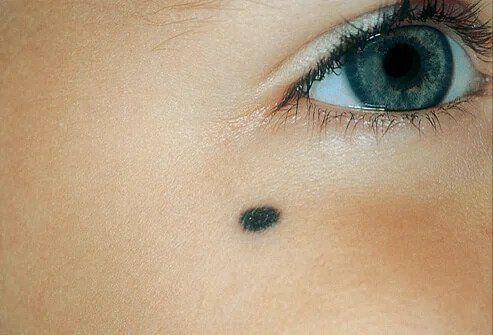 bentuk blue nevus (medicinenet.com)