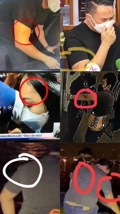 Kumpulan foto bukti luka goresan di tubuh para tersangka (twitter.com/pawatt)