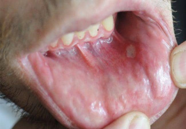 ilustrasi sariawan pada pasien penyakit Behçet (consultqd.clevelandclinic.org)