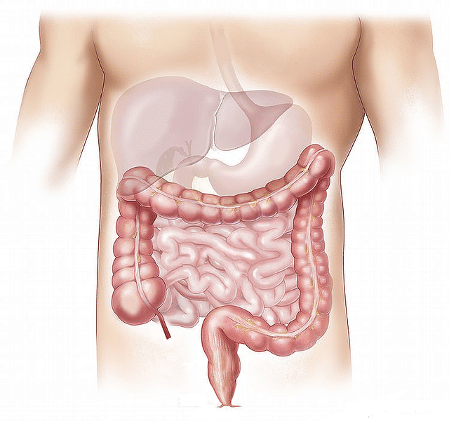 Intususepsi: Penyebab, Gejala, Diagnosis, dan Pengobatan