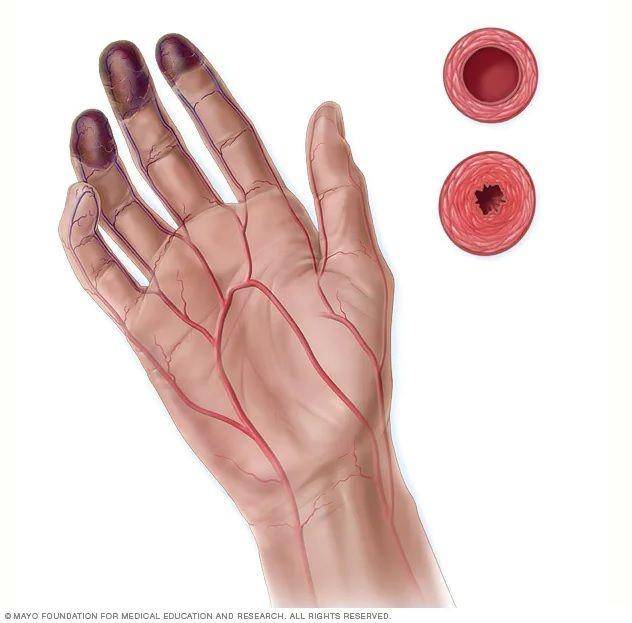 ilustrasi penyakit Buerger (mayoclinic.org)