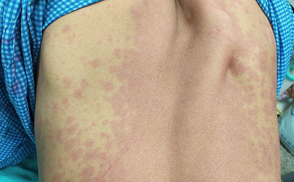 Gejala red man syndrome (bmj.com)
