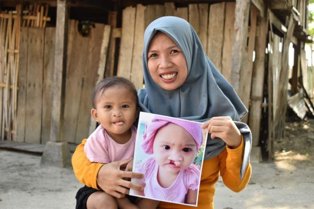 Cara Daftar Operasi Bibir Sumbing Gratis di Bandar Lampung
