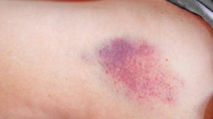 ilustrasi petechiae atau pendarahan di bawah kulit (healthgrades.com)