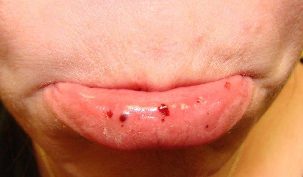 ilustrasi petechiae di bagian dalam bibir (commons.wikimedia.org/Mdscottis)