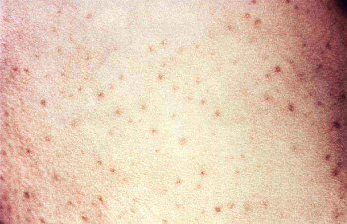 ilustrasi petechiae (phil.cdc.gov)