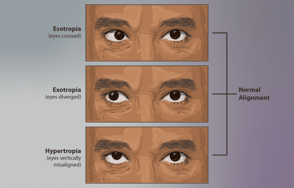 ilustrasi esotropia, exotropia, dan hypertropia (myupchar.com)