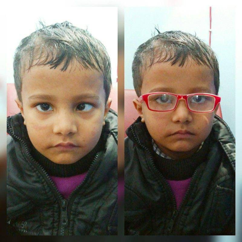 ilustrasi kacamata untuk esotropia pada anak (flickr.com/IAPB/VISION 2020/Lal Mahammad/Kiran Eye Hospital, Birgunj, Nepal)