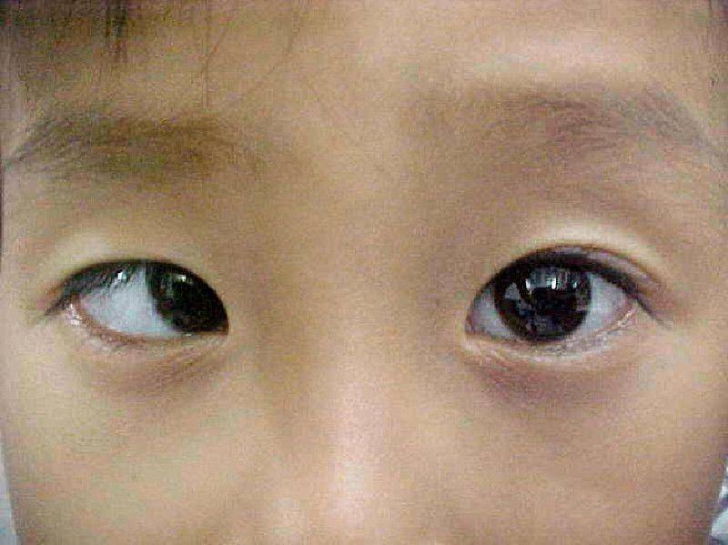 ilustrasi esotropia (flickr.com/Community Eye Health/Photo: ORBIS)