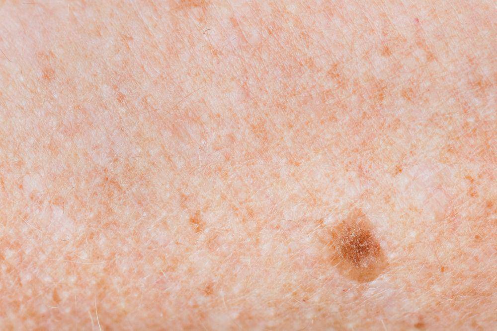 ilustrasi melanoma, salah satu jenis kanker kulit (freepik.com/rawpixels.com)