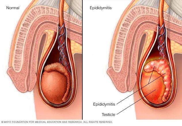 ilustrasi epididimitis (mayoclinic.org)