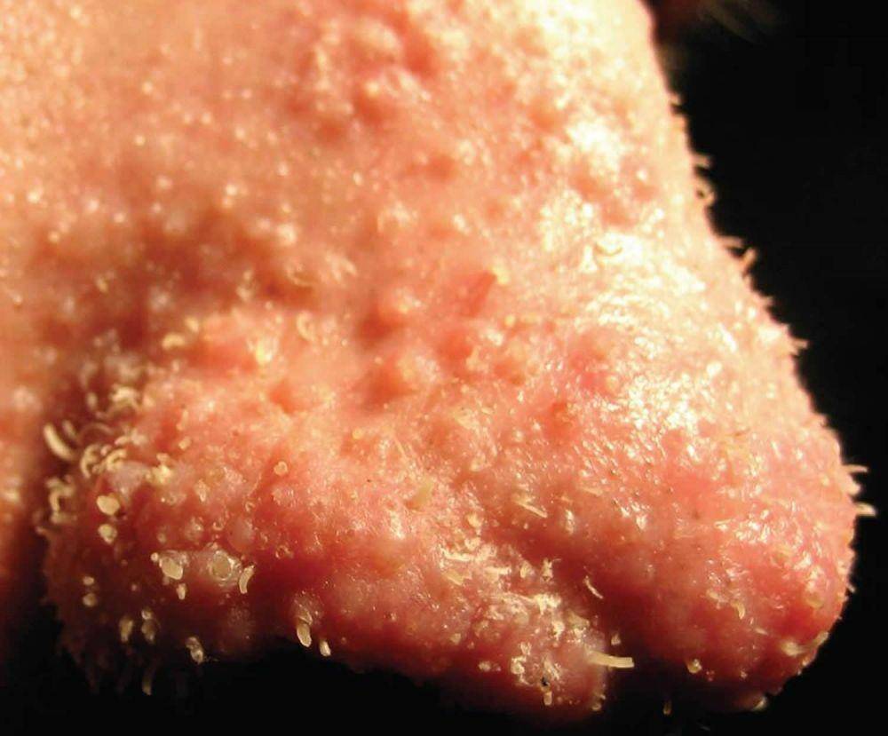 ilustrasi trichostasis spinulosa (healthjade.net)