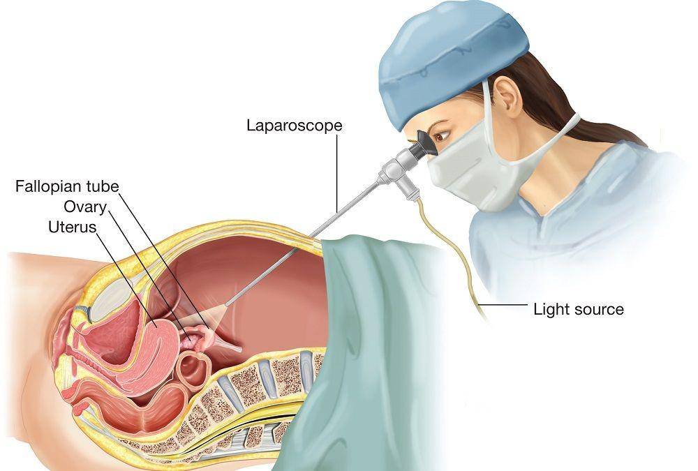 ilustrasi laparoskopi (laparoscopysurgeries.com)