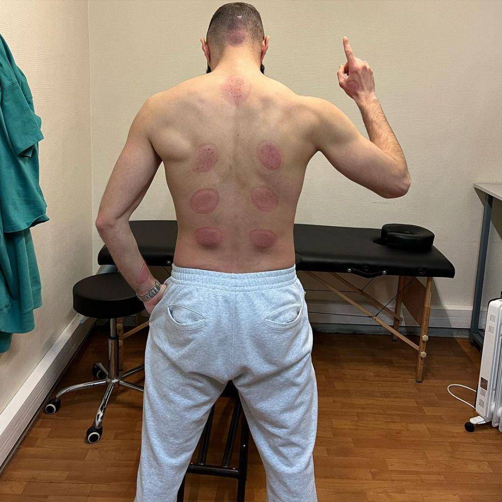 Karim Benzema menunjukkan hasil bekam di punggungnya. (instagram.com/karimbenzema)