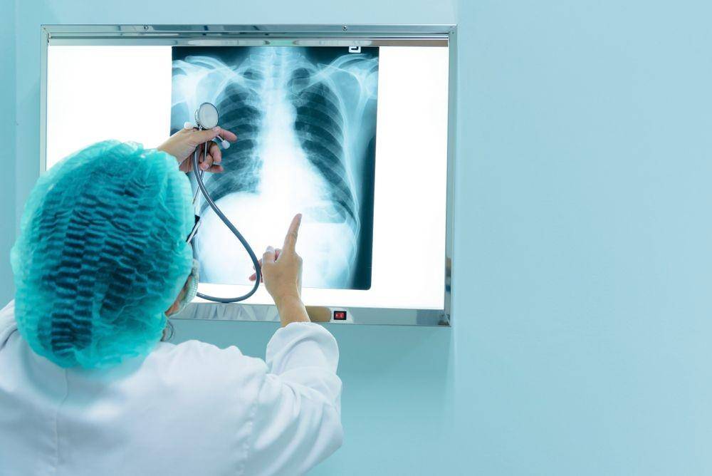 Seorang dokter memeriksa foto rontgen bagian paru-paru. (ShutterStock/KomsanLoonprom)