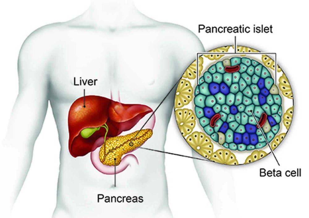 ilustrasi insulinoma (healthjade.net)