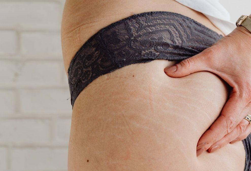 ilustrasi stretch mark (pexels.com/Karolina Grabowska)