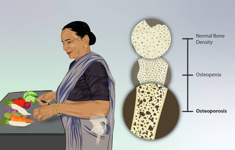 ilustrasi osteporosis (commons.wikimedia.org/https://www.myupchar.com/en)