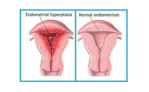 ilustrasi hiperplasia endometrium (kjkhospital.com)