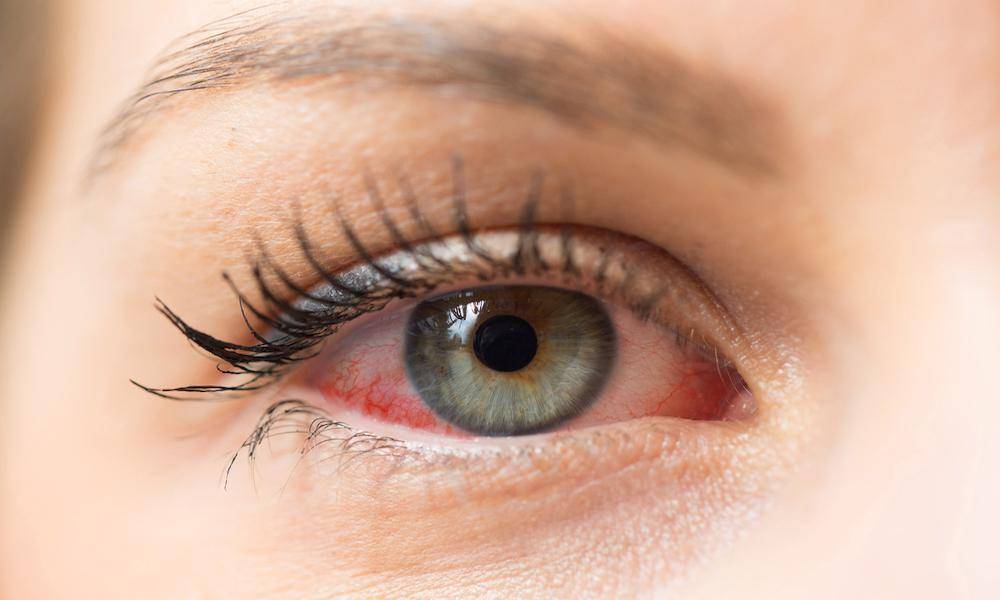 ilustrasi mata kering (www.smarteyecare.nyc)