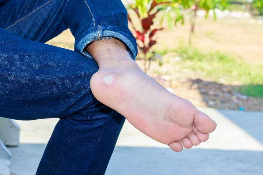 ilustrasi kaki yang terkena fibroma plantar (gotofootdoc.com