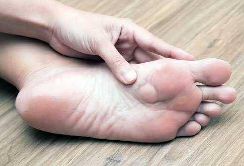 ilustrasi fibroma plantar (emedicinehealth.com)