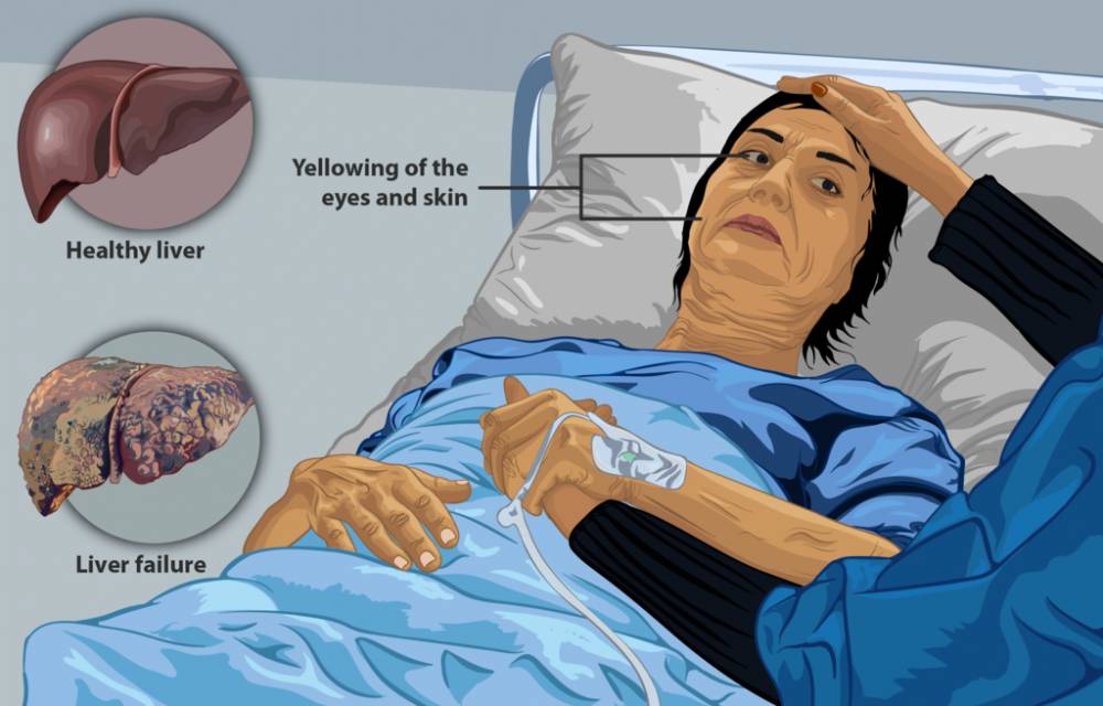 ilustrasi gagal hati (commons.wikimedia.org/https://www.myupchar.com/en)