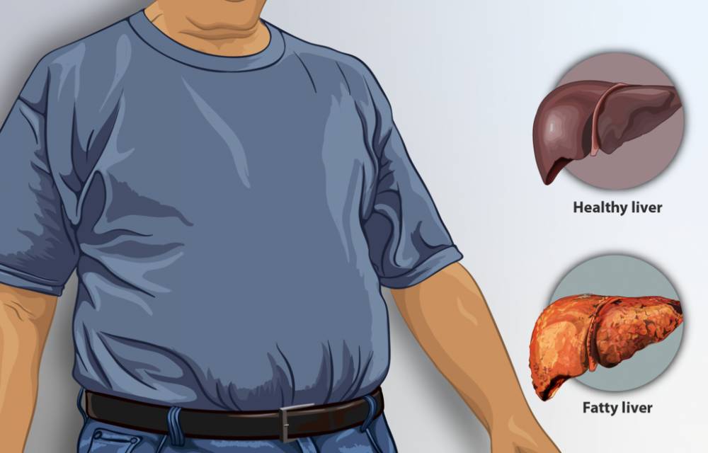 ilustrasi organ hati (commons.wikimedia.org/https://www.myupchar.com/en)