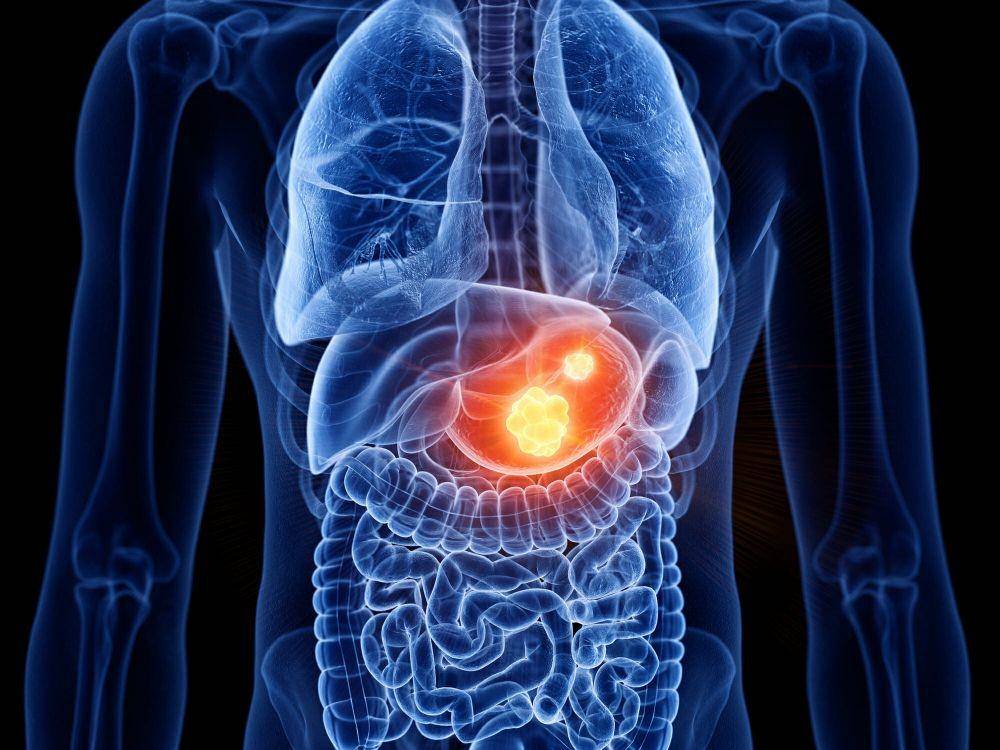 ilustrasi gastrointestinal stromal tumor atau GIST (rarediseaseadvisor.com)