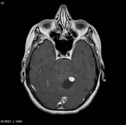 ilustrasi hemangioblastoma (radiopaedia.org)