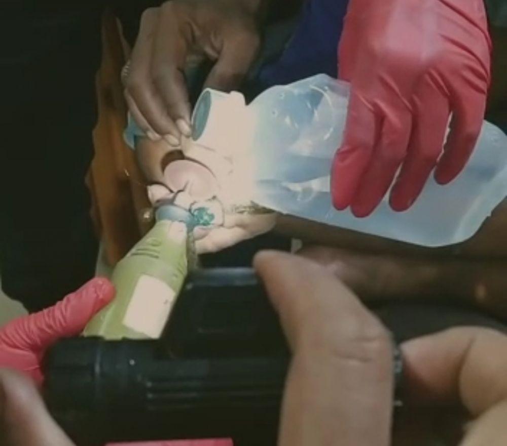 Ngeri, Cincin Ibu Ini Tersangkut di Jari Hingga Tulang Patah