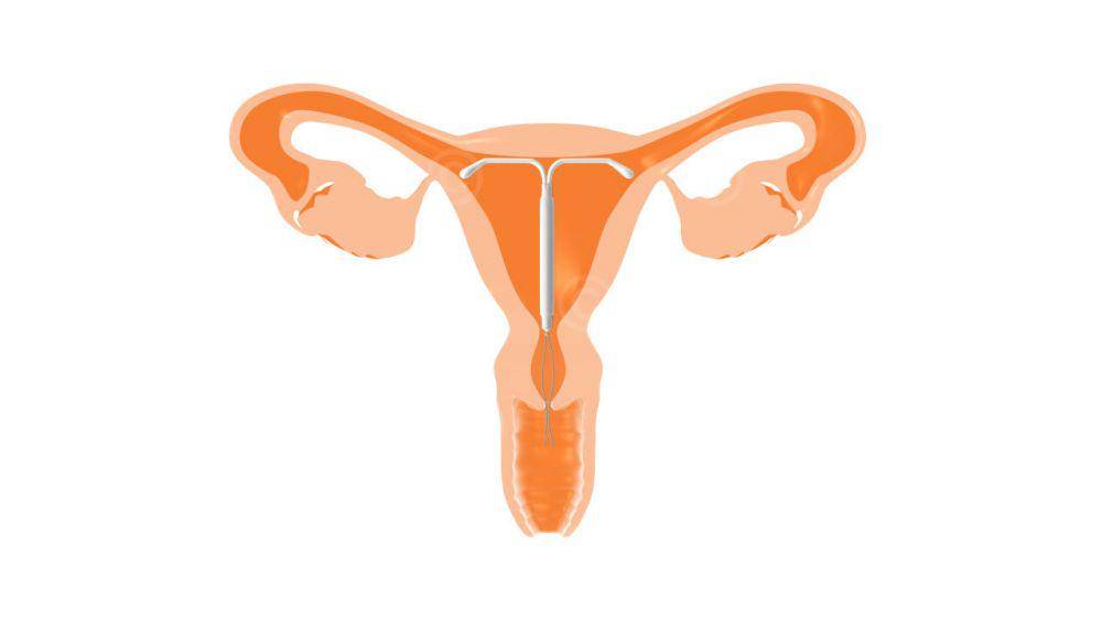 ilustrasi intrauterine device (IUD) (medicalgprahics.com)