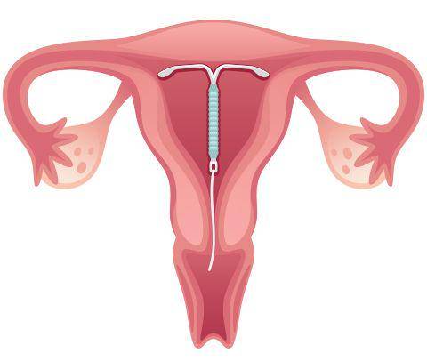 ilustrasi intrauterine device (IUD) (womensgroupofgwinnett.com)