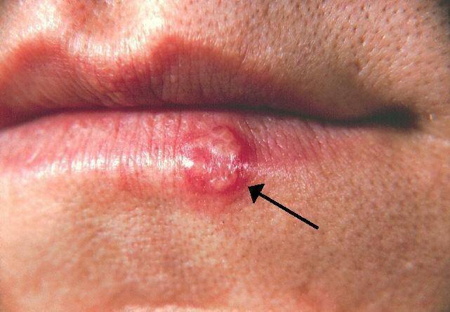 ilustrasi herpes (wikipedia.org)