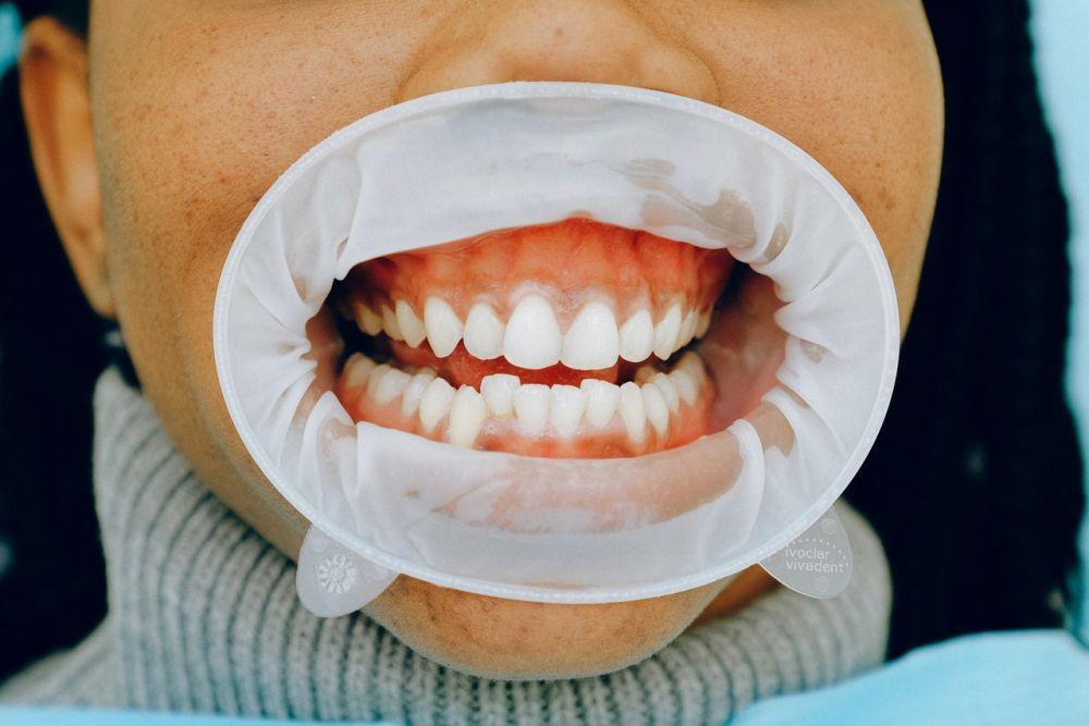 Gusi Turun (Resesi Gingiva): Penyebab, Gejala, Perawatan
