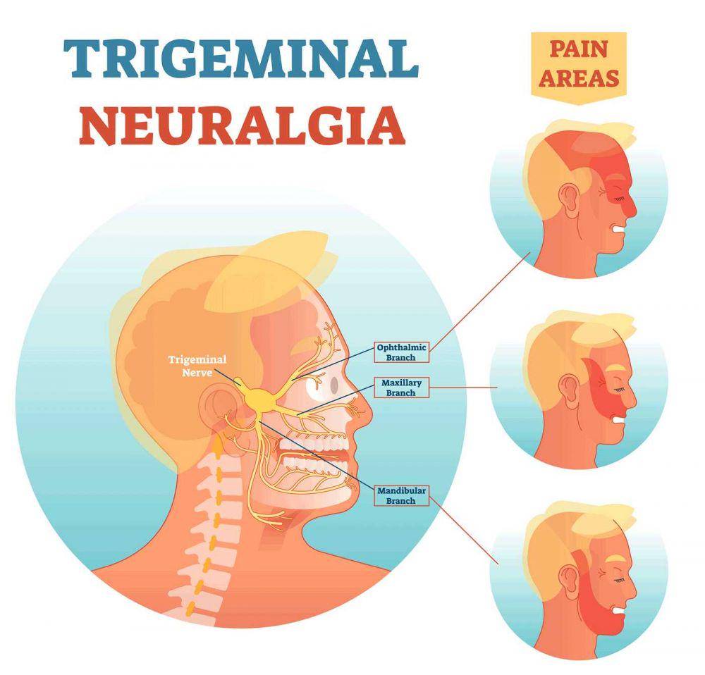 ilustrasi trigeminal neuralgia atau neuralgia trigeminal (hopkinsmedicine.org)
