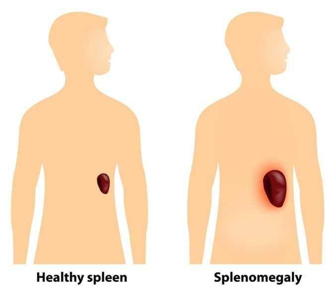 ilustrasi splenomegali (news-medical.net)