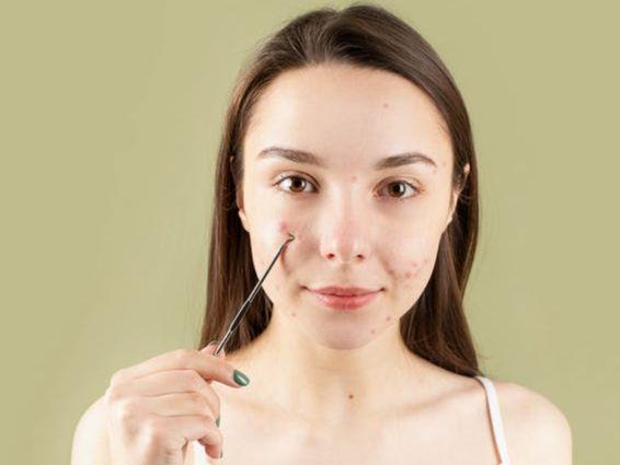 11 Rekomendasi Acne Spot Treatment, Mampu Basmi Jerawat dalam Sekejap