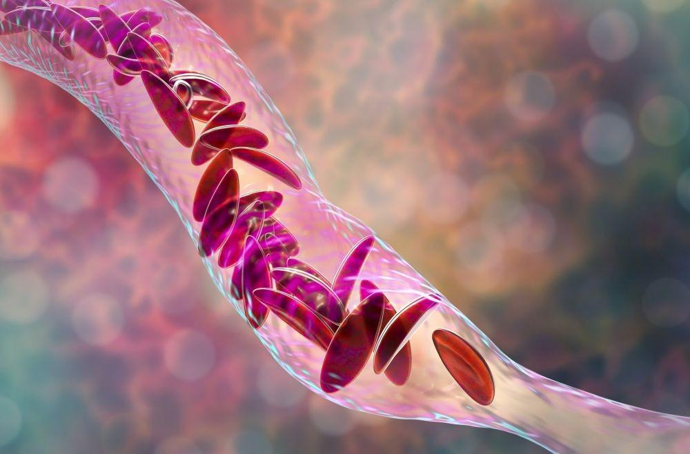 Anemia Sel Sabit: Penyebab, Gejala, Komplikasi, Pengobatan