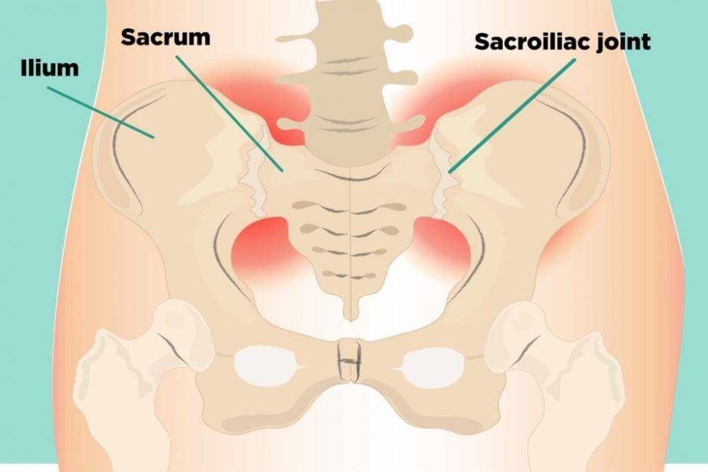 ilustrasi sakroiliitis atau sacroiliitis (creakyjoints.org)
