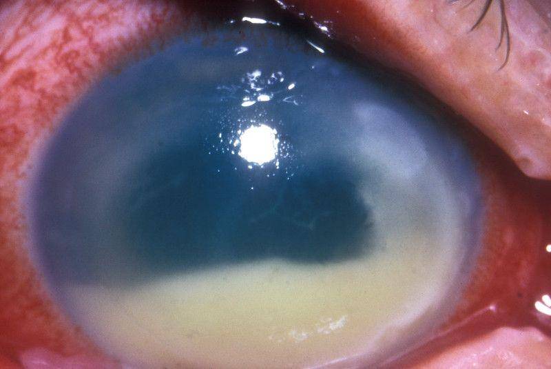 Endoftalmitis dengan hipopion luas yang konsisten dengan infeksi aktif. (flickr.com/Community Eye Health/International Centre for Eye Health iceh.lshtm.ac.uk, London School of Hygiene & Tropical Medicine)