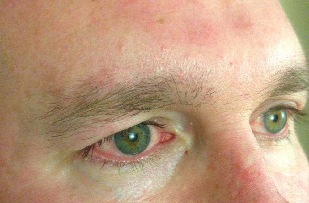 Bagaimana Cara Konjungtivitis Menular?