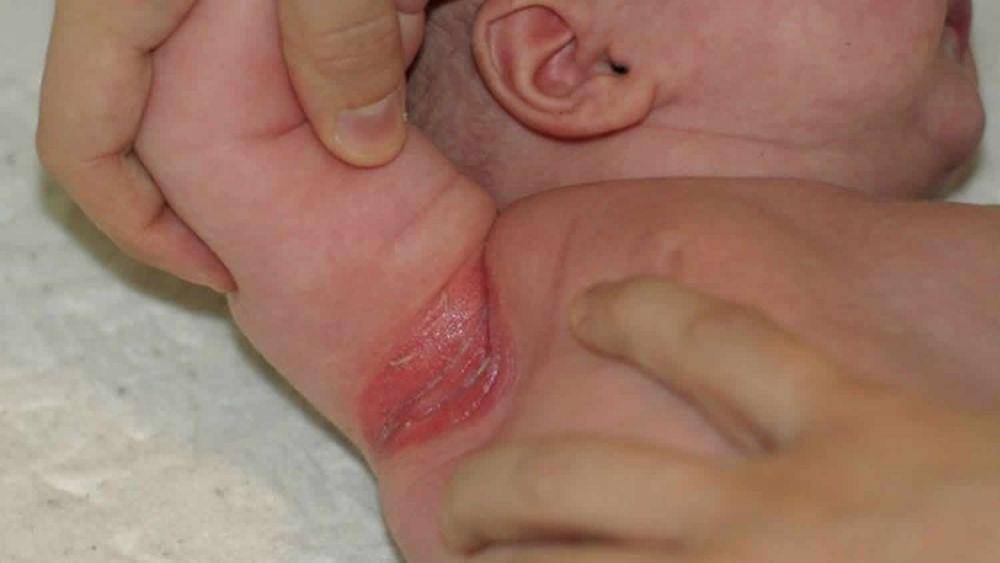 ilustasi intertrigo di ketiak bayi (healthjade.com)